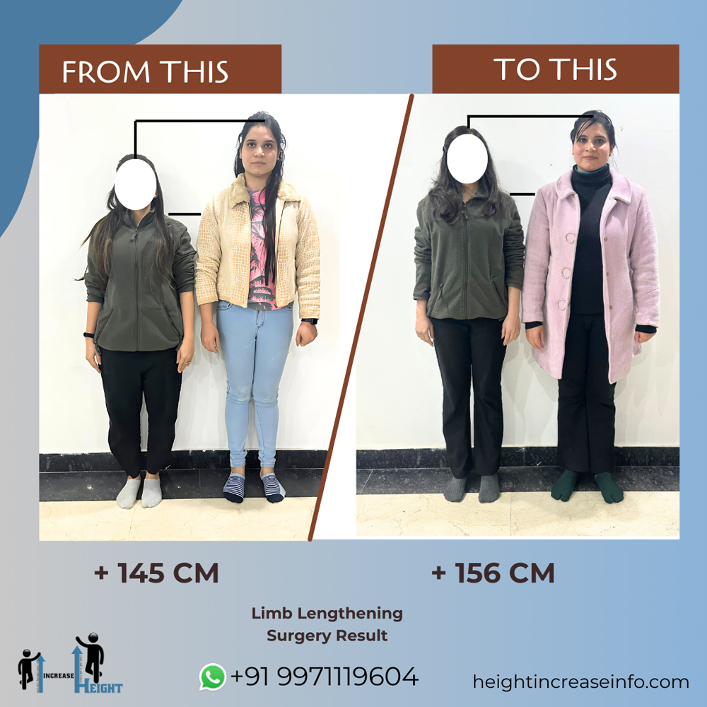 Limb Lengthening Result 1